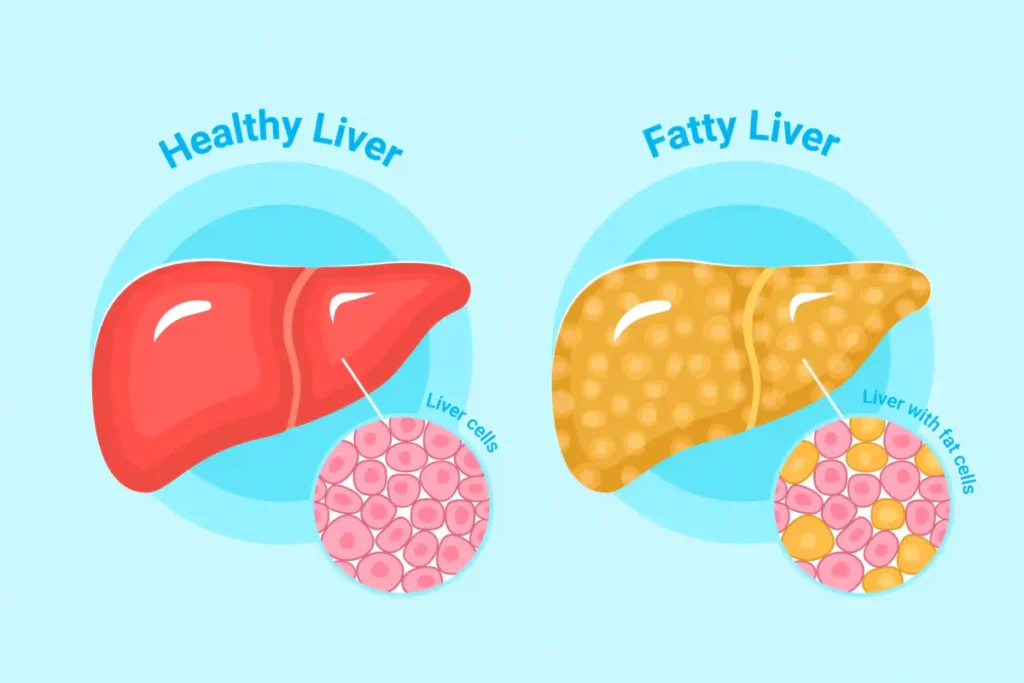 What Is a Liver Detox?