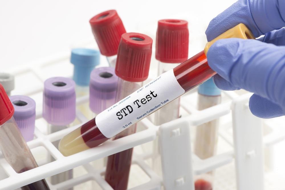 What Is an STD Test?